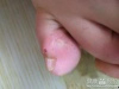 激光打鸡眼视频,视频见证神奇疗效